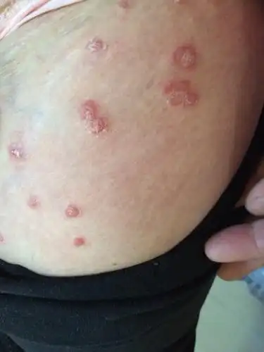 谁能帮我看看这是什么皮肤病,好多年了