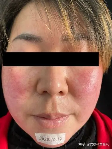 皮肤受损玫瑰痤疮