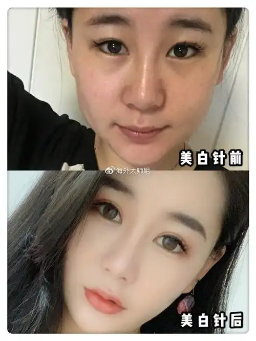 美白针前后对比