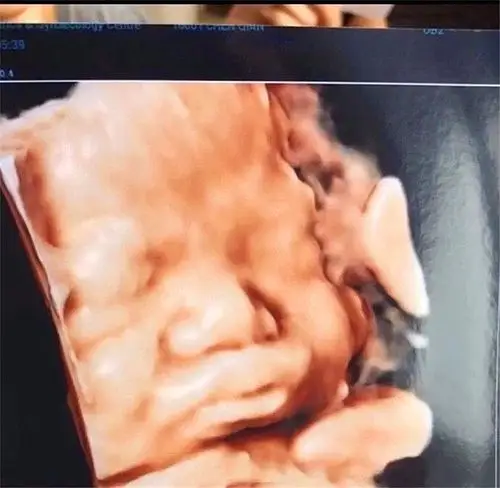 孕妈做b超发现娃嘴歪了,医生安慰说正常,宝宝出生后妈妈被丑哭