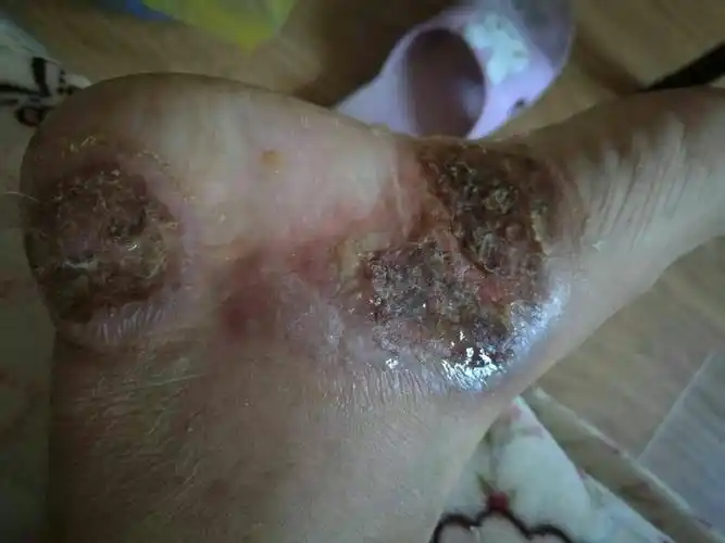 脚上皮肤溃烂病例分享