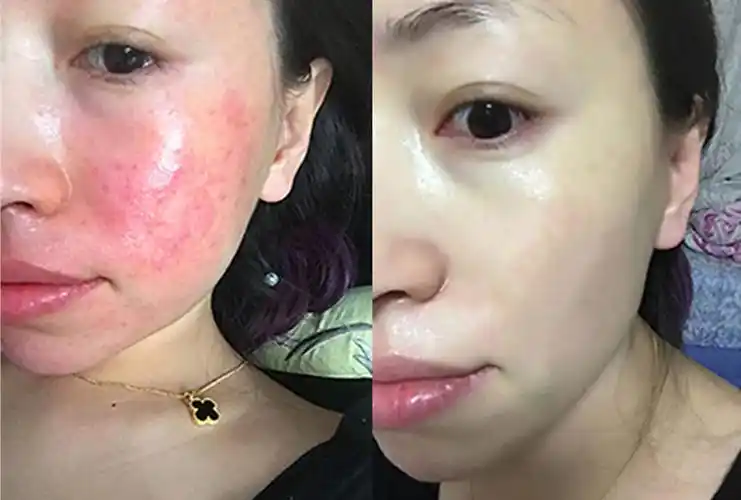 【精】怎么摆脱脸部红痒过敏肌肤,敏感肌修复用什么方法好?