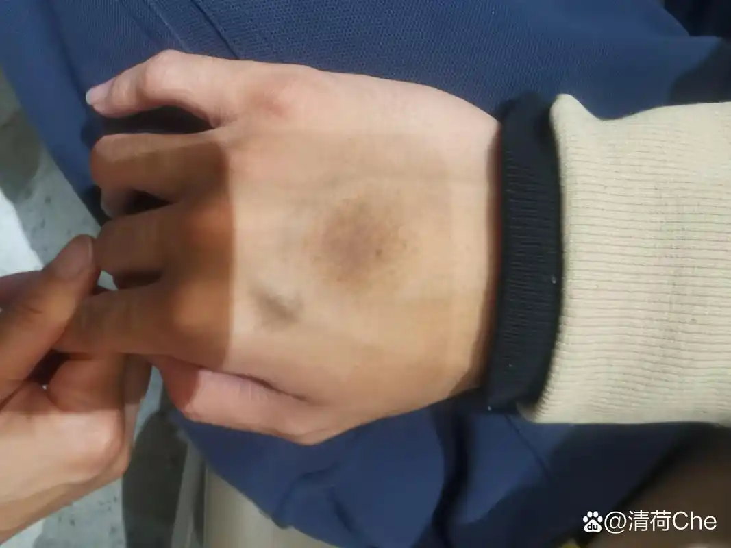 这属于什么痣,手心主贵还是手背主福?