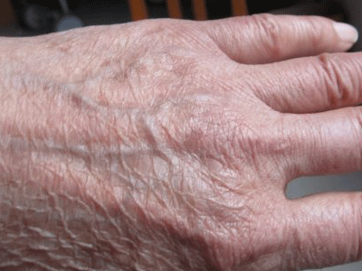 老年人老年性皮肤改变与老年皮肤瘙痒症