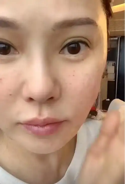 秦昊老婆跑韩国打水光针56岁伊能静满脸针眼感慨真的很痛