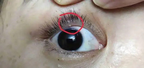 眼睛上长了一粒小东西,这是什么情况?