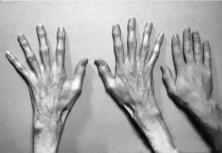 马方综合征的主要病征