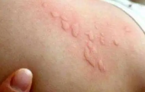 螨虫咬伤后会在皮肤产生红色丘疹,丘疱疹,水疱或丘疹性荨麻疹样的皮疹