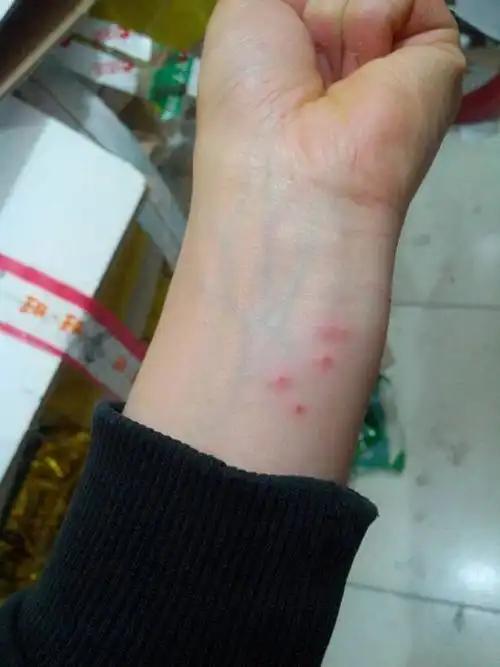 跳蚤咬的红疙瘩图片