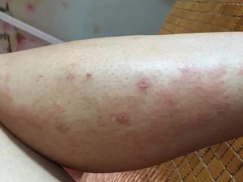 冬天季节性手足湿疹的症状