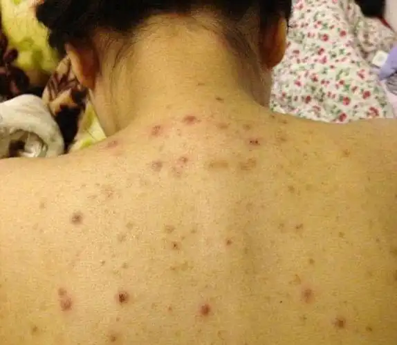 后背一直能扣出米粒说明后背螨虫上亿