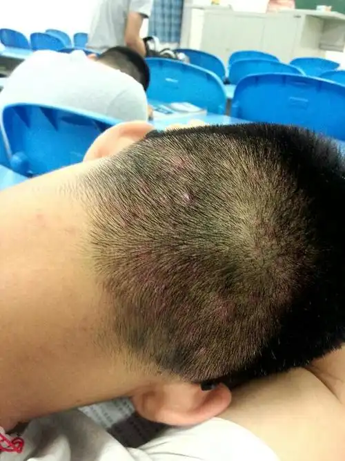 头上长的红疙瘩,既痒又痛,好久了,平常都是长出来几天就下去了,这次都