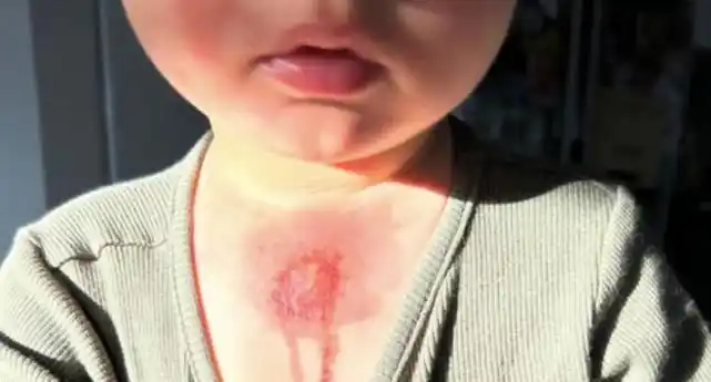 澳男童榨橙汁双手被灼伤,满是水泡,酸橙是主要原因