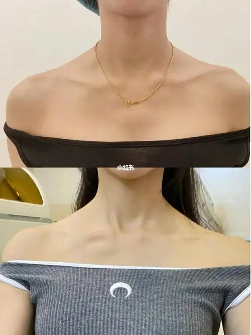 斜方肌特别硬的,建议打瘦肩针,美化肩膀线条的同时还可以放松肌肉,太