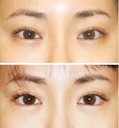 下睑下至术的介绍