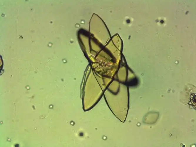 让人痛不欲生的尿酸结晶居然这么美