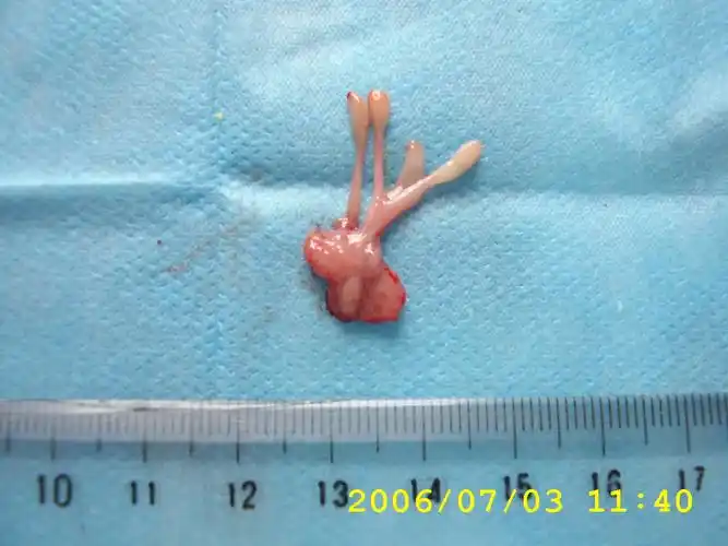 输尿管息肉的诊治体会(附18例报告) - 好大夫在线