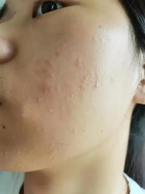 脸上长了好多闭口(慎入)