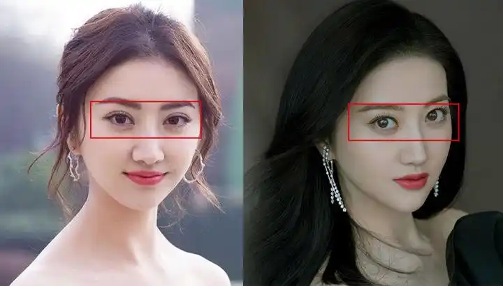 双眼皮过宽可以修窄吗