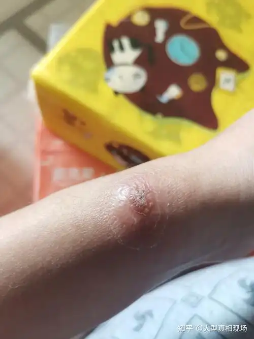 记一笔长疖肿火疖子自己治疗的过程