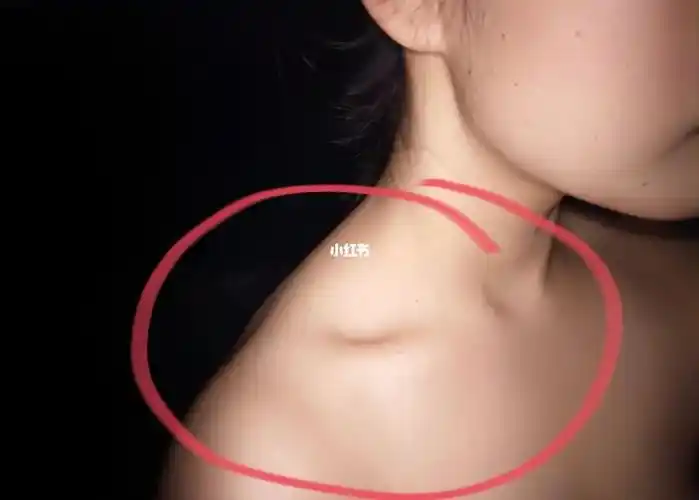 斜方肌怎么消除