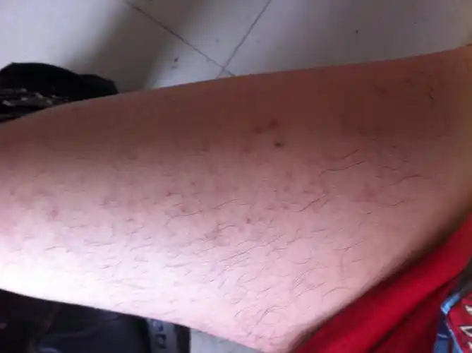 大腿上这样是毛囊炎吗我每天都穿牛仔裤裤子经常摩擦到大腿