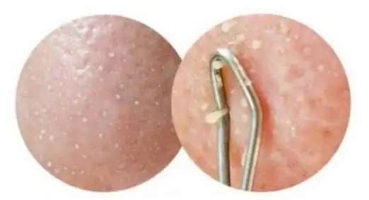 毛孔不断挤出来的小颗粒是什么真的是螨虫吗