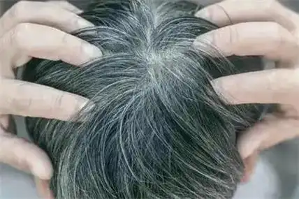 白发原因