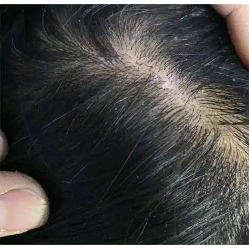 控油去屑止痒防脱发?_头皮屑_头发_问题