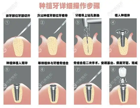 种植牙的步骤以及骨结合后的操作