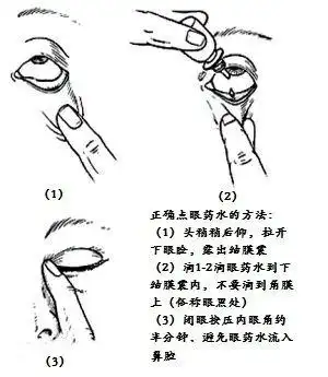 眼膏/眼用凝胶的使用方法及注意事项使用方法:涂眼:用手指往下拔开你