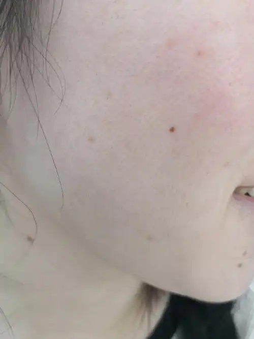 一条plog告别八月##色素痣##解决皮肤问题专注皮肤美容