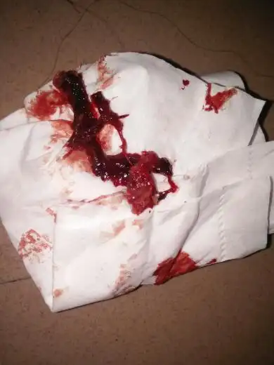 月经两个月来的,有点痛经,腰酸,第二天有像肉一