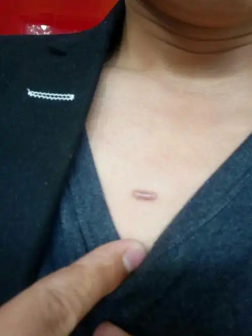 胸口表皮张了一块儿小肉球,之前用手挤过,感觉越挤越大,这是什么东西