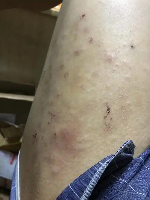 大腿外侧痒怎么回事啊?