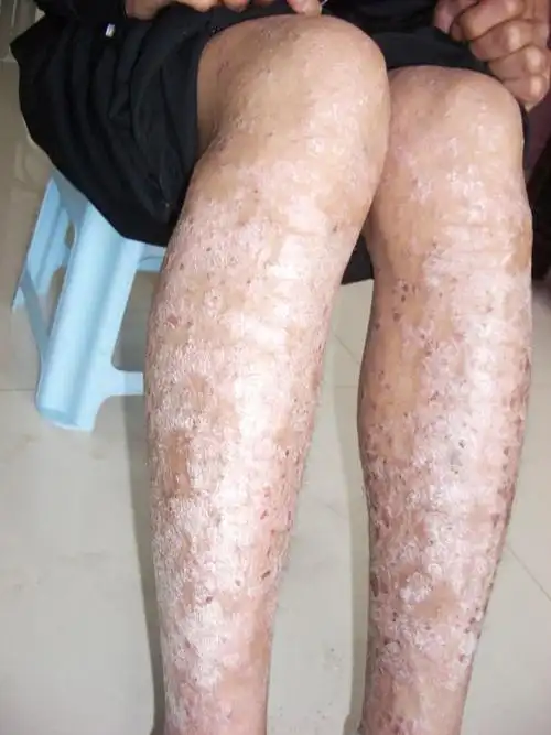 襄阳治疗牛皮癣银屑病_襄阳治疗牛皮癣_李氏皮肤病