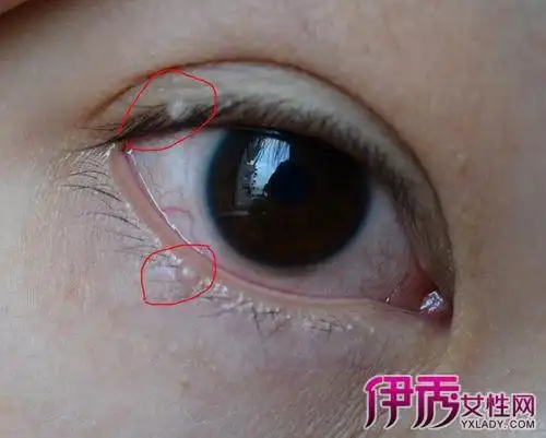 【图】眼皮里面长了个小白点怎么办? 5个小贴士助你消灭它