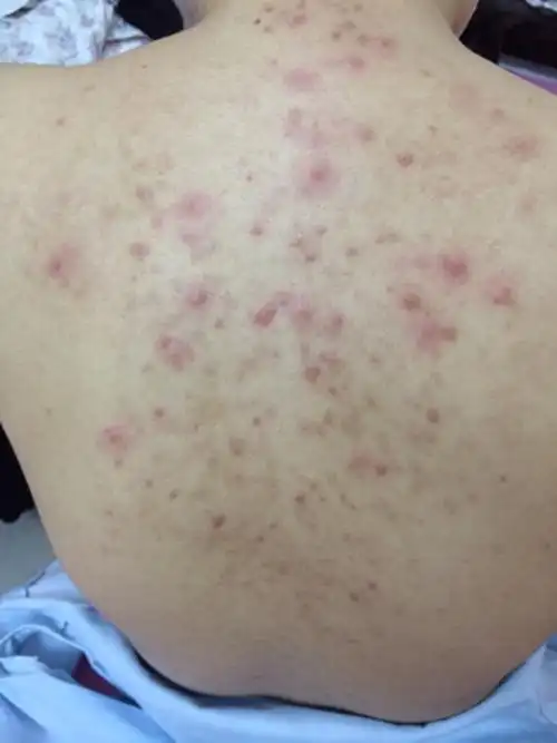 痤疮图片_痤疮症状表现图片大全_有来医生