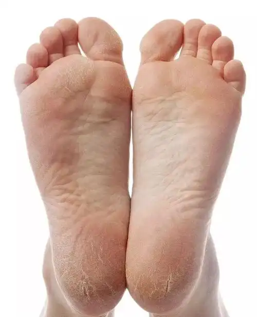 肝脏好不好,脚知道,如果你的脚是这样的,恭喜你,肝脏很健康!_脚底