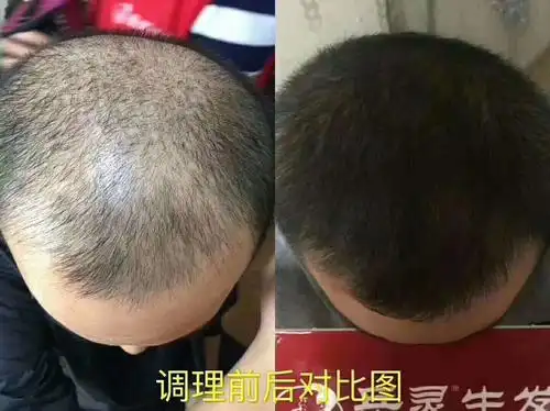 免费解决您头油,头屑,脱发白发等头皮不适困扰 - 美篇