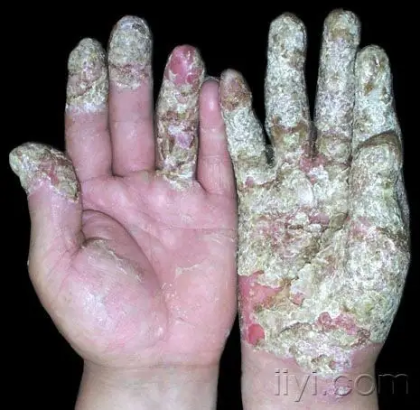 表皮上部苍白,染色淡,可见有广泛的单个角质形成细胞坏死