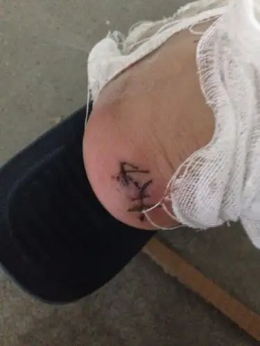 伤口发炎不处理会怎样 2007-12-14 胃穿孔手术后 导致伤口发炎 算不算