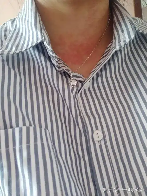 过敏性皮炎怎么治疗