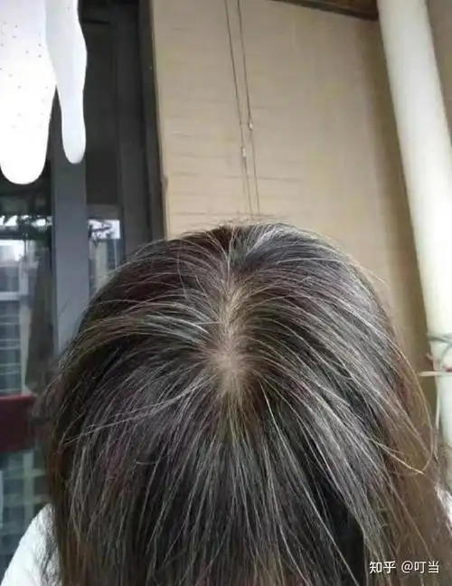 生完孩子白发越来越严重,差点抑郁了,现在白发好了真是心情都不一样了