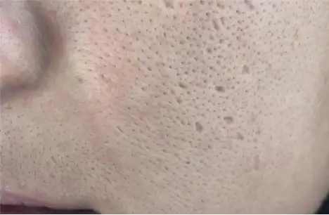 比如皮肤粗糙,毛孔粗大等,很多女性朋友都遇到过这种情况,那么毛孔