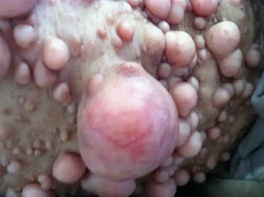 皮下脂肪瘤图片46