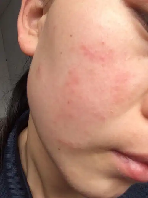 洗完脸之后又干又痒,就像是过敏是的,各位亲们有什么好办法吗