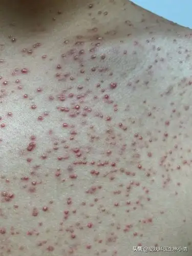 马拉色菌性毛囊炎,又称糠秕孢子菌性毛囊炎.