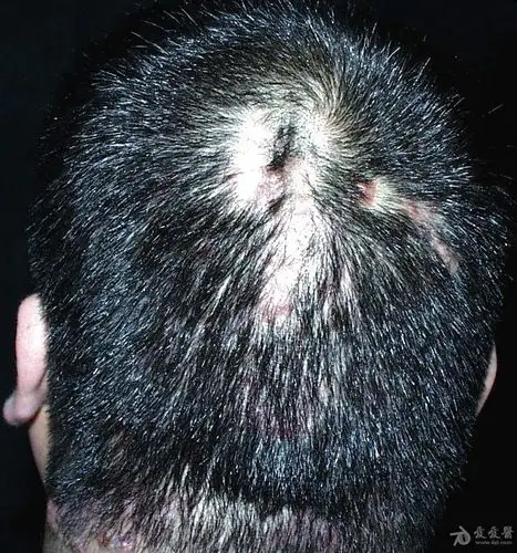 皮肤性病图谱☆有☆奖☆点☆评☆25:头部穿掘性毛囊炎.