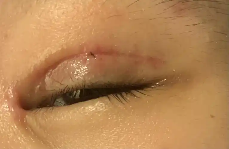 我的眼皮上的黑点拽出一个线结怎么办